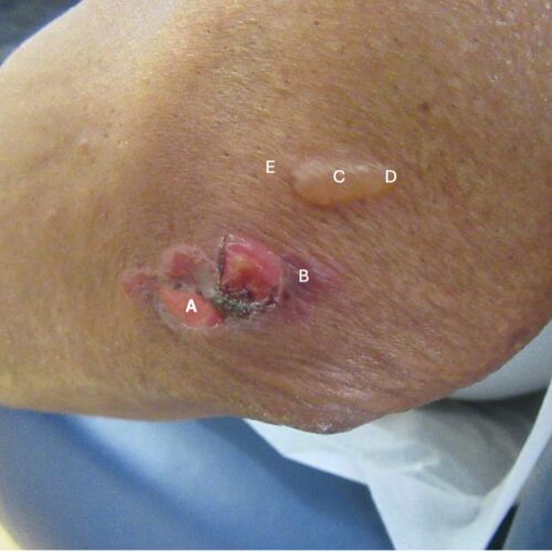 Bullous pemphigoid case figure
